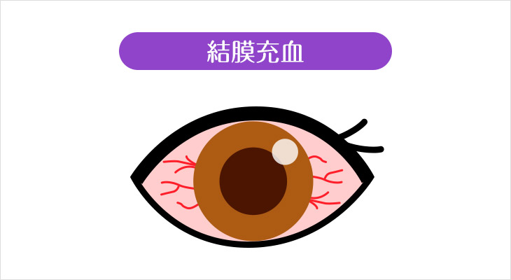 カラコンで目が真っ赤 充血の原因と充血を治す7つの方法 モアコンタクト モアコン 公式カラコン通販