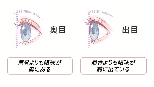 奥目と出目の特徴について